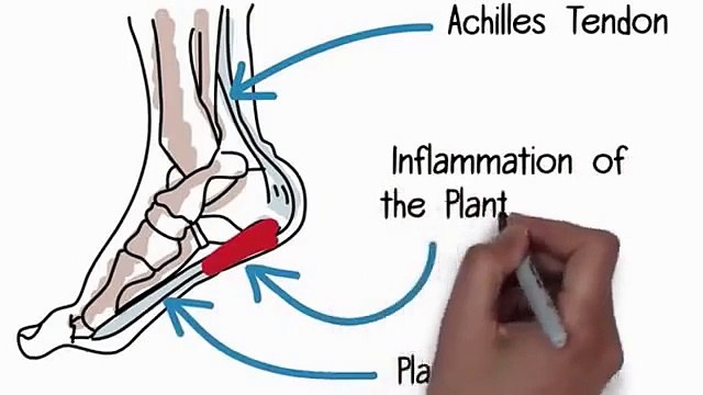 Plantar Fasciitis Treatment | Fast Plantar Fasciitis Cure | bunion treatment