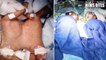 Conjoined Twins Separated at Just 8 Days Old