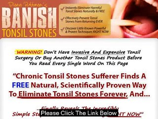 Is It Worth To Get Banish Tonsil Stones Guide?