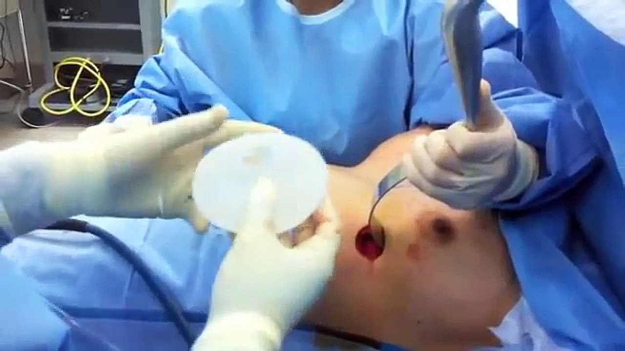 Aumento de busto / Breast Implants Dr. Guillermo Hernandez Gonzalez, Ars Plastica