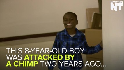 Boy Gets Rare Lip Reconstruction After Getting Attacked By Chimp