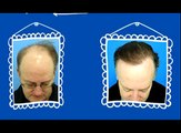 Hair Loss Protocol 101 review  my real experience