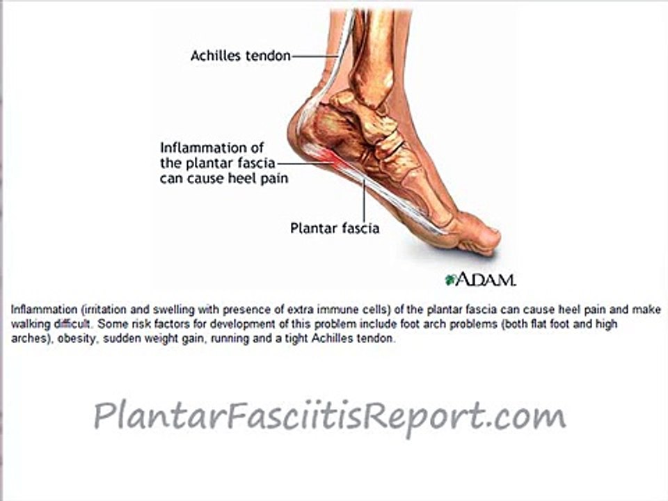 How Does Plantar Fasciitis Happen?