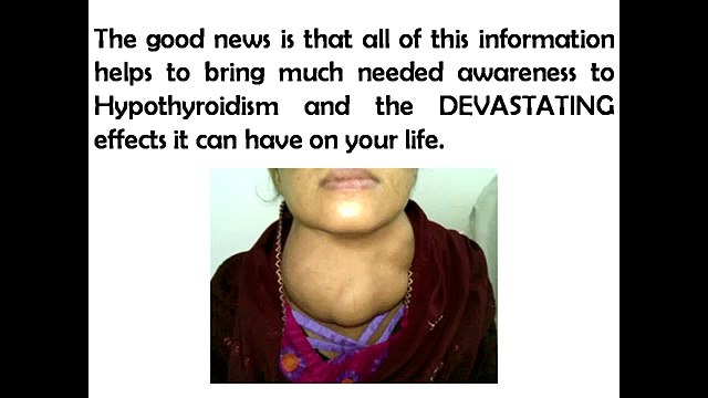 The Hypothyroidism Revolution Diet Plan | Best Diet For Hypothyroidism