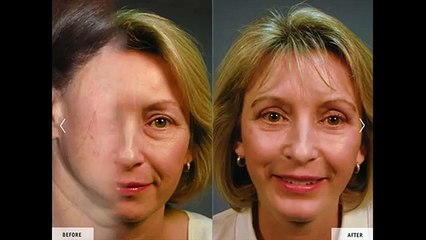 Facelift Without Surgery: How to get one in Miami?