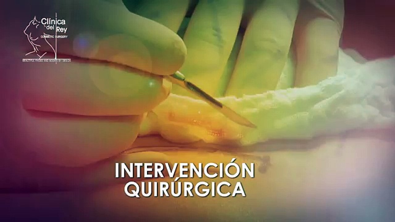 AUMENTO DE BUSTO CON LIPOESCULTURA::BREAST AUGMENTATION AND LIPOESCULTURE::CLINICA DEL REY