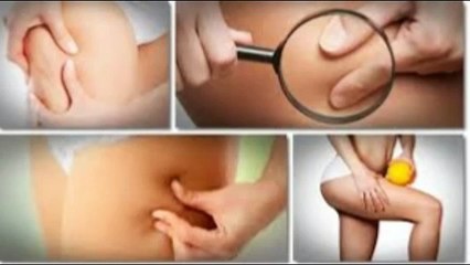 Cellulite Factor / cellulite factor program Review + Bonus