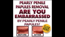 Pearly Penile Papules Removal Review | Amazing Pearly Penile Papules Removal Review By Josh Marvin