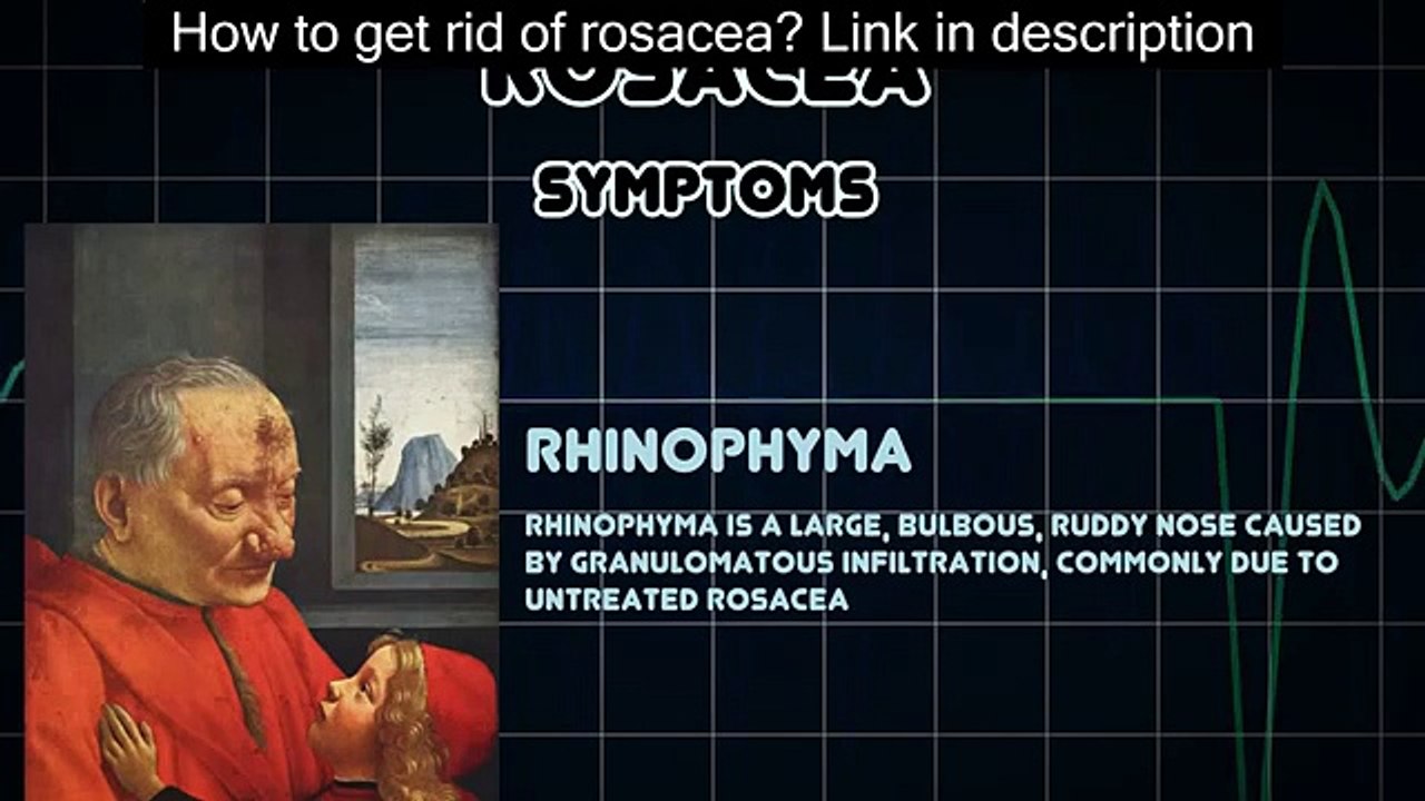 Rosacea (Medical Condition) - rosacea - what is rosacea laser treatment?