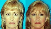 Plastic surgery gone wrong facelift without surgery