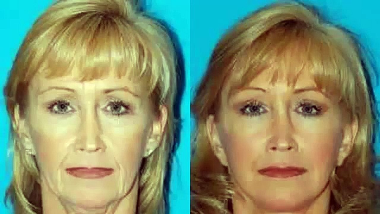 Plastic surgery gone wrong facelift without surgery