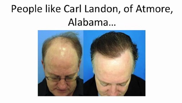 Hair loss protocol 101 Program It is Scam??