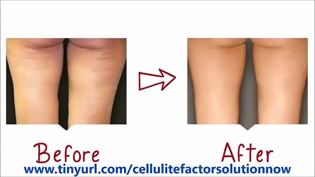 Cellulite Factor Solution System | Amazing Cellulite Factor Solution System By Charles Livingston