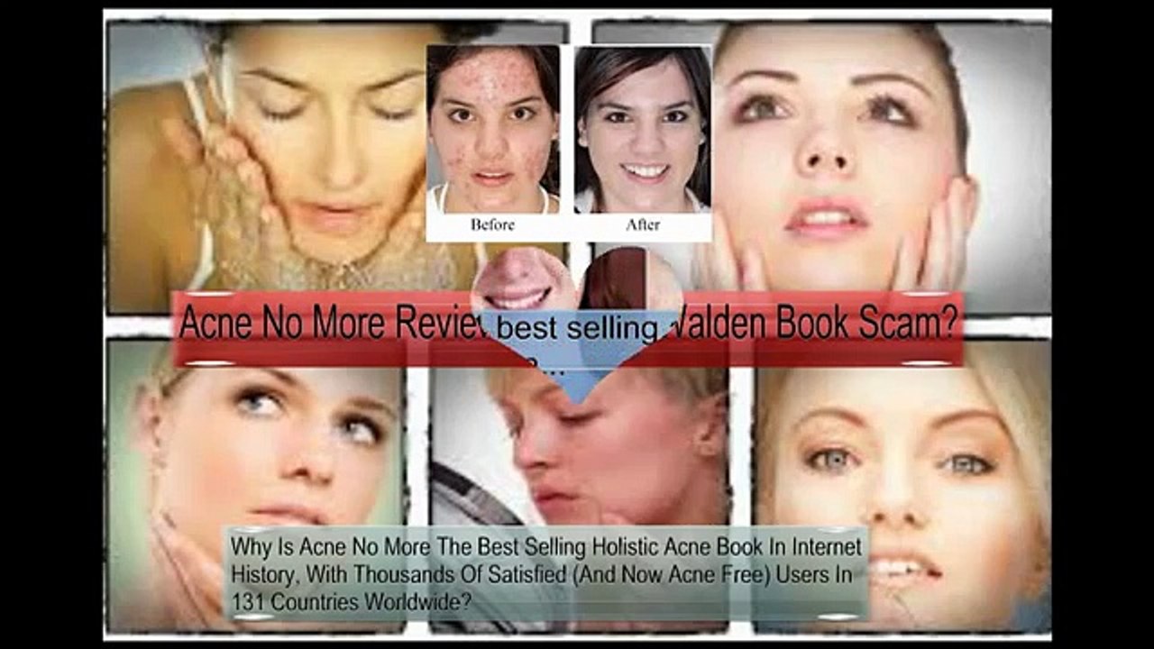 Acne No More Reviews - Is Mike Walden Book Scam?