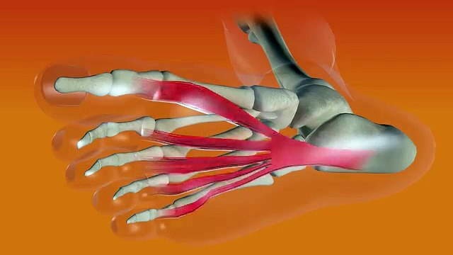 What is Plantar Fasciitis? How to quickly and easily relieve heel pain!