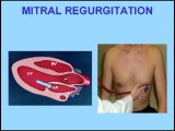 Heart Sounds - Mitral Regurgitation vs Mitral Stenosis (480p)