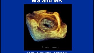 Heart Sounds - Mitral Stenosis and Regurgitation Variations (480p)