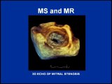 Heart Sounds - Mitral Stenosis and Regurgitation Variations (480p)