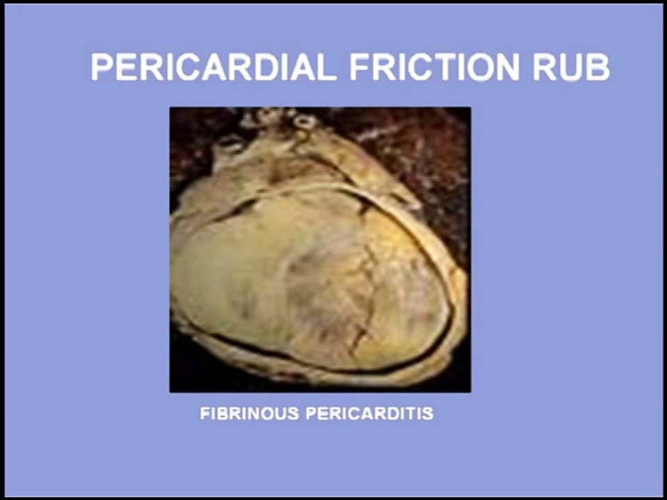 Heart Sounds - Pericardial Rub and Innocent Systolic Murmur (480p)