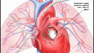 Heart Sounds Made Easy - Congenital Heart Defects (480p)