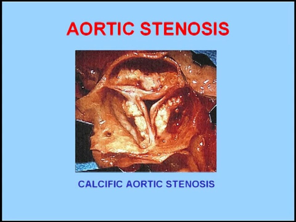 Heart Sounds - Aortic Stenosis vs Aortic Regurgitation (480p)