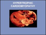 Heart Sounds - Hypertrophic Cardiomyopathy and Mitral Valve Prolapse (480p)