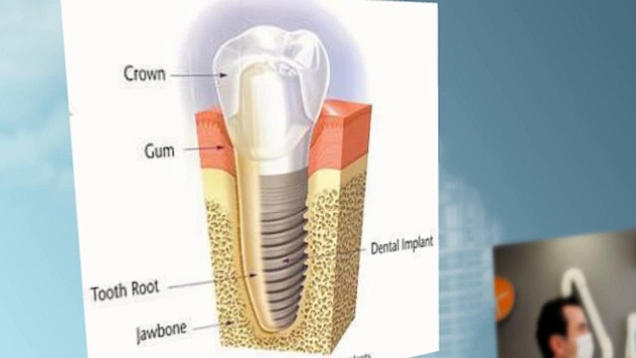 tooth-replacement
