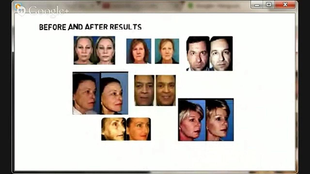 Best Facelift Without Surgery | Best Way To Get A Facelift Without Surgery