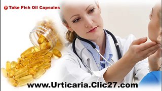 Chronic Urticaria Relief  | Urticaria Relief Itching