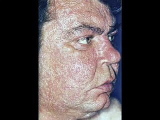 Dr. Darm Aesthetic Medicine - Rosacea