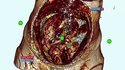 3D Эмбрион на память - 3D Embryo as souvenir