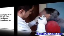 Acne Severo Tratamiento Natural | El Milagro Para el Acne [Como Eliminar Barros y Espinillas]
