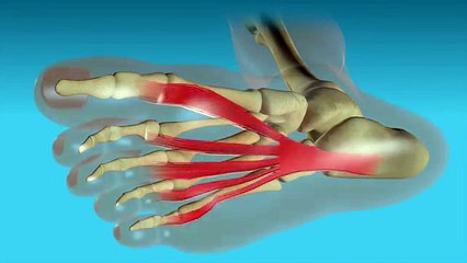 What is Plantar Fasciitis?