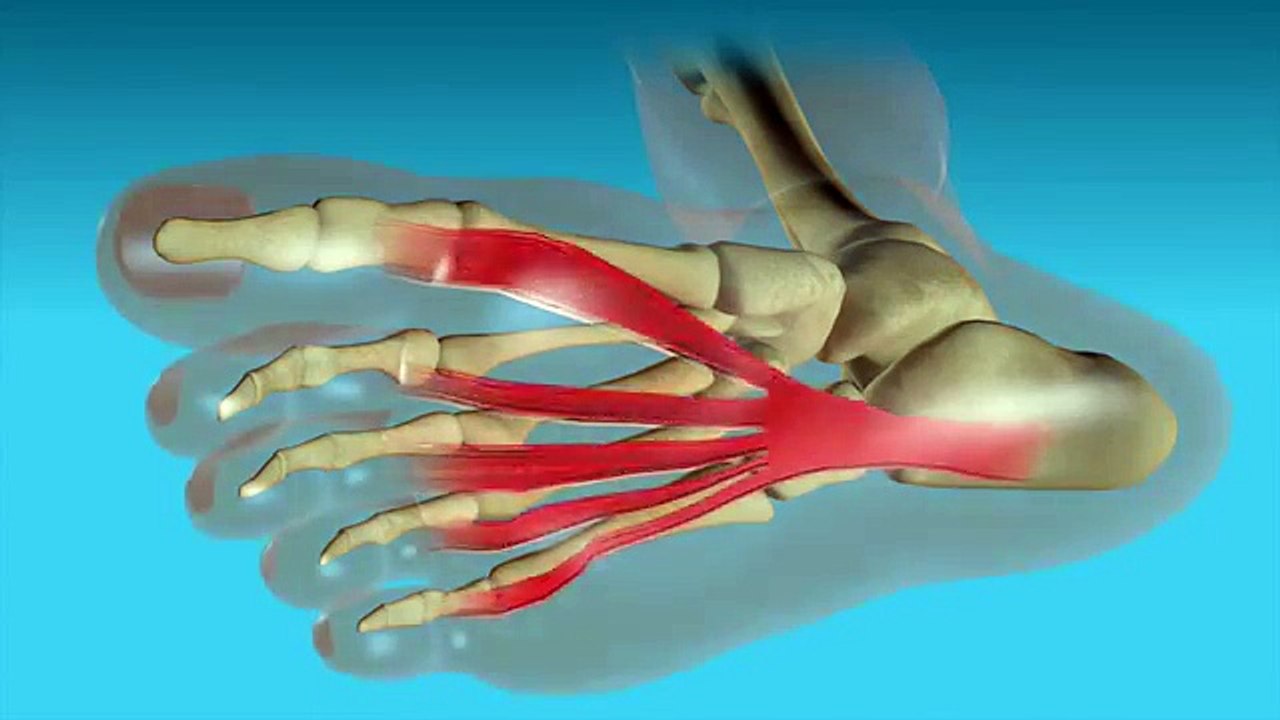 What is Plantar Fasciitis?