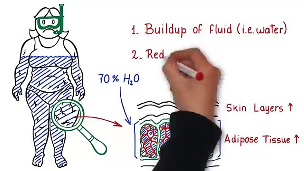 Cellulite Factor: Secret To Reducing The Apearence Of Cellulite