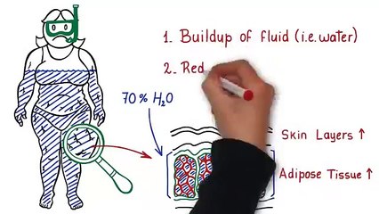 Cellulite Factor: Secret To Reducing The Apearence Of Cellulite