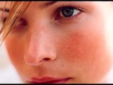 Rosacea Pictures - Symptoms,Photos, Images and Pictures of Rosacea