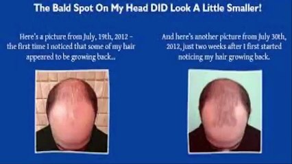Hair Loss Protocol Review || How Hair Loss Protocol Works?