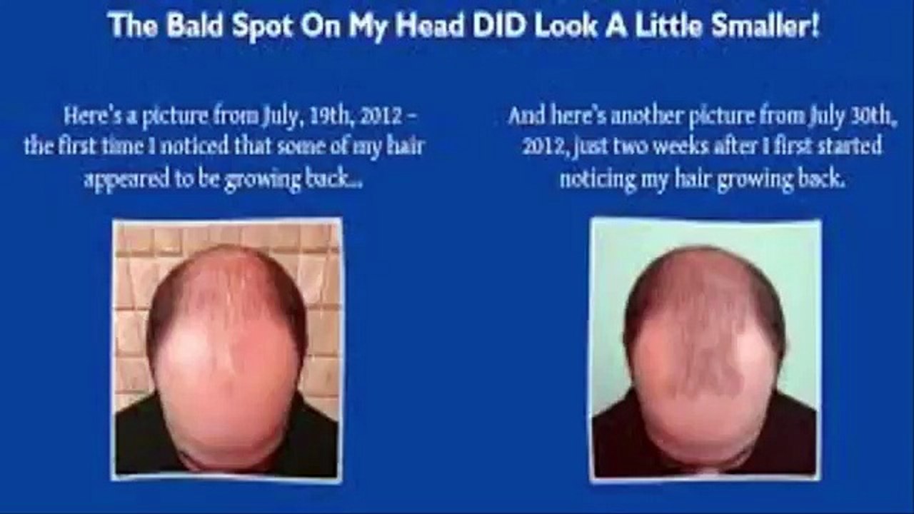 Hair Loss Protocol Review || How Hair Loss Protocol Works?