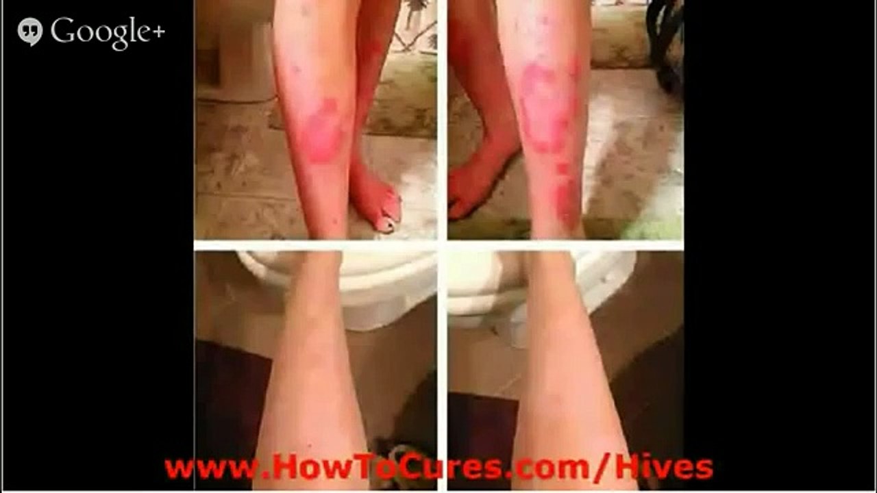 How To Get Rid Of Hives On Face - Cures For Allieviating Urticaria Hives - How To Get Rid Of Hives O