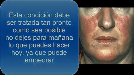 Rosacea Cura | 3 Cosas que debarias saber sobre la Rosacea