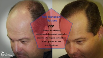 Hair Transplant Options in Istanbul, Turkey