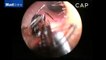 Des médecins indiens ont extrait une colonie de fourmis dans l'oreille d'une fillette de 12 ans