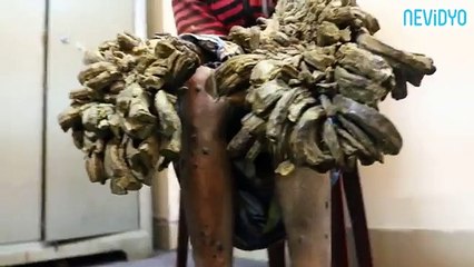 Ağaç adam sonunda ameliyat oluyor