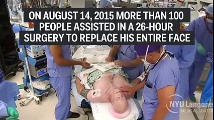 Sergons completed Most Complex Facial Transplant