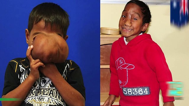 Австралийские врачи удалили нарост с лица филиппинского мальчика