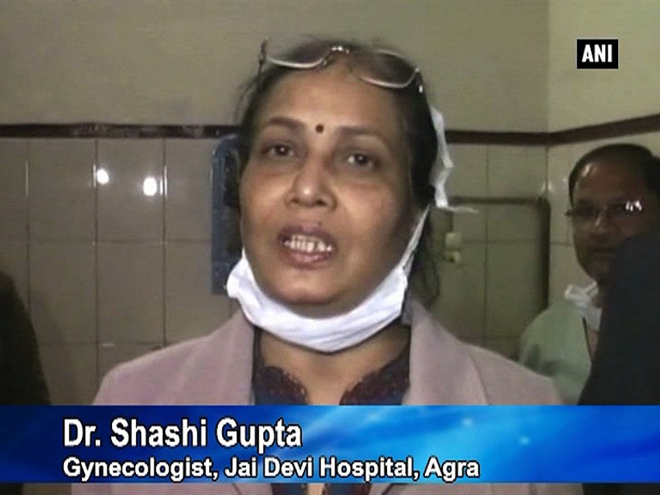 Conjoined twins born in Agra