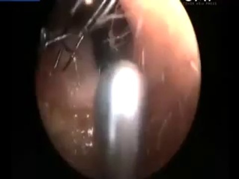 12 Year Old Girl In India Has An Ant Nest Inside Her Ear! (Doctors Remove Over 1,000 Ants) (720p Full HD)