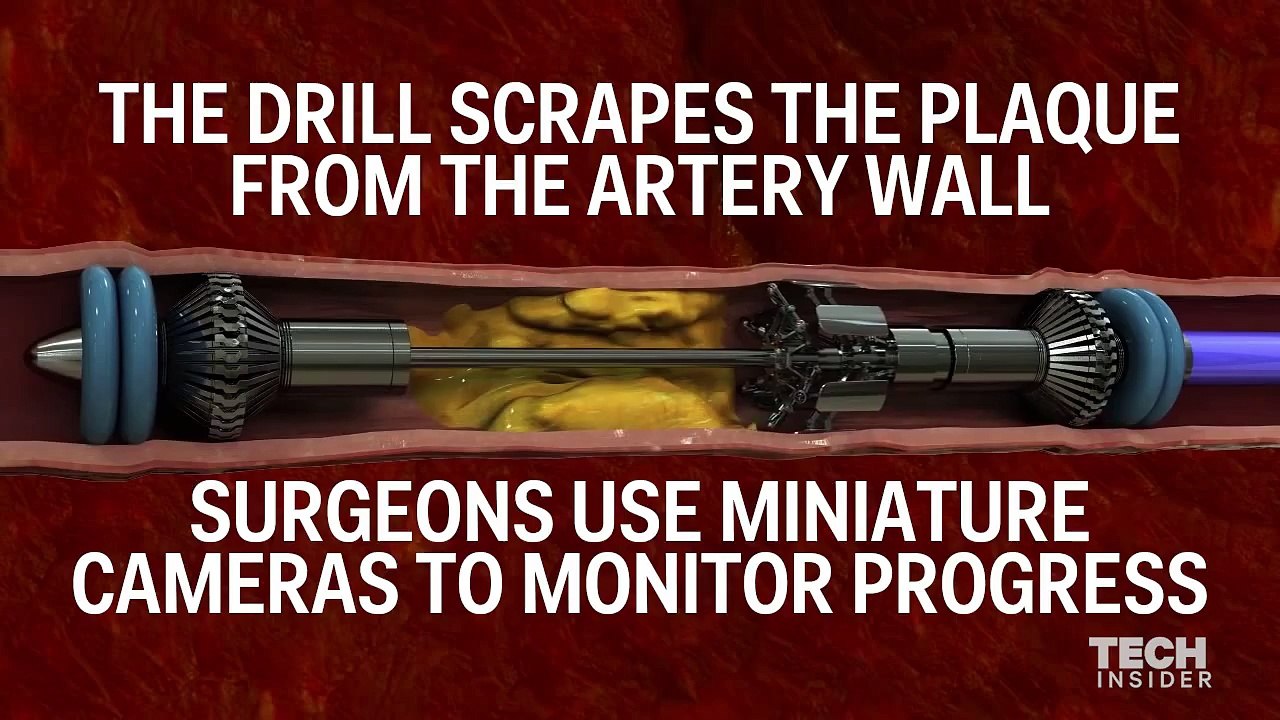 Cholesterol-eating device