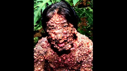 Dünya Üzerindeki En İlginç 5 Hastalık ( Biraz Korkunç Olabilir)